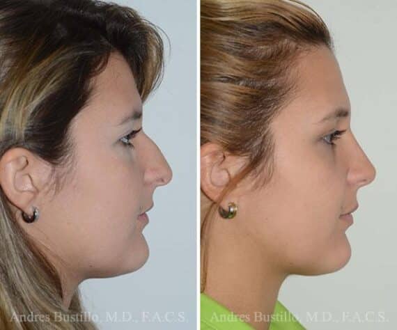 Rhinoplasty Before and After Photos in Miami, FL, Patient 15886