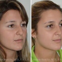 Rhinoplasty Before and After Photos in Miami, FL, Patient 15886