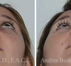 Rhinoplasty Before and After Photos in Miami, FL, Patient 15886