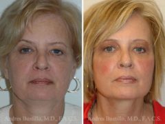 Deep Plane Facelift Before and After Photos in Miami, FL, Patient 15727