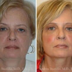 Deep Plane Facelift Before and After Photos in Miami, FL, Patient 15727