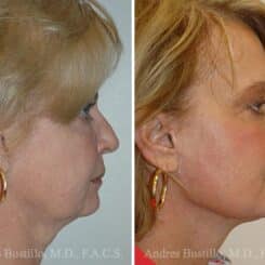 Deep Plane Facelift Before and After Photos in Miami, FL, Patient 15727
