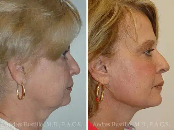 Deep Plane Facelift Before and After Photos in Miami, FL, Patient 15727