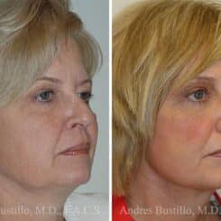 Deep Plane Facelift Before and After Photos in Miami, FL, Patient 15727