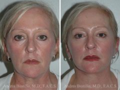 Deep Plane Facelift Before and After Photos in Miami, FL, Patient 15734