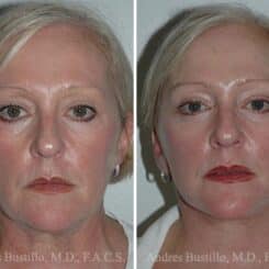 Deep Plane Facelift Before and After Photos in Miami, FL, Patient 15734
