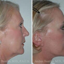 Deep Plane Facelift Before and After Photos in Miami, FL, Patient 15734