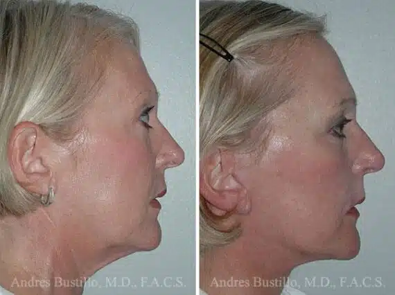 Deep Plane Facelift Before and After Photos in Miami, FL, Patient 15734