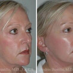 Deep Plane Facelift Before and After Photos in Miami, FL, Patient 15734