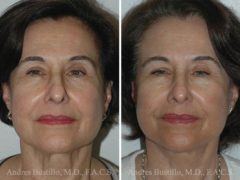 Deep Plane Facelift Before and After Photos in Miami, FL, Patient 15748