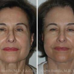 Deep Plane Facelift Before and After Photos in Miami, FL, Patient 15748