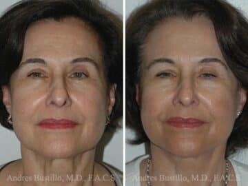 Deep Plane Facelift Before and After Photos in Miami, FL, Patient 15748