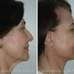 Deep Plane Facelift Before and After Photos in Miami, FL, Patient 15748