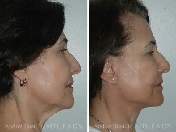Deep Plane Facelift Before and After Photos in Miami, FL, Patient 15748