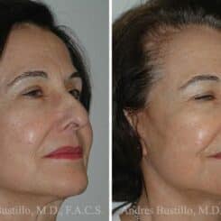 Deep Plane Facelift Before and After Photos in Miami, FL, Patient 15748