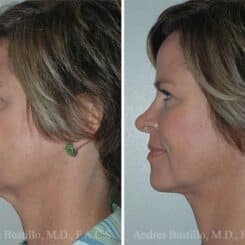 Minimal Incision Neck Lift Before and After Photos in Miami, FL, Patient 15769