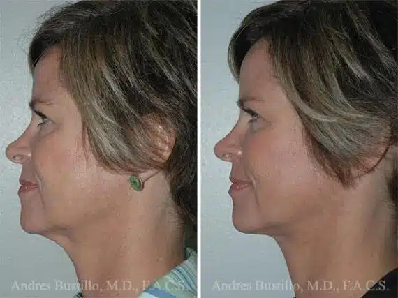 Minimal Incision Neck Lift Before and After Photos in Miami, FL, Patient 15769