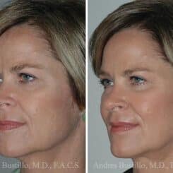 Minimal Incision Neck Lift Before and After Photos in Miami, FL, Patient 15769