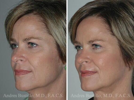 Minimal Incision Neck Lift Before and After Photos in Miami, FL, Patient 15769