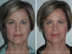 Minimal Incision Neck Lift Before and After Photos in Miami, FL, Patient 15769