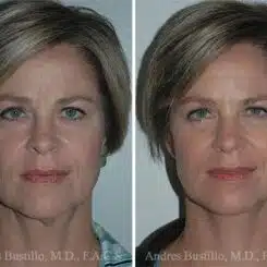 Minimal Incision Neck Lift Before and After Photos in Miami, FL, Patient 15769