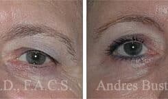 Blepharoplasty (eyelids) Before and After Photos in Miami, FL, Patient 15776