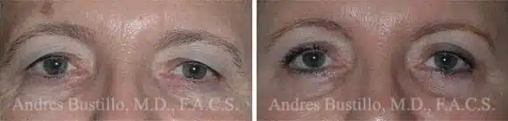 Blepharoplasty (eyelids) Before and After Photos in Miami, FL