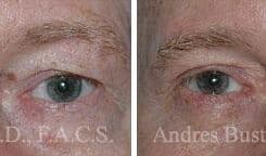 Blepharoplasty (eyelids) Before and After Photos in Miami, FL, Patient 15782