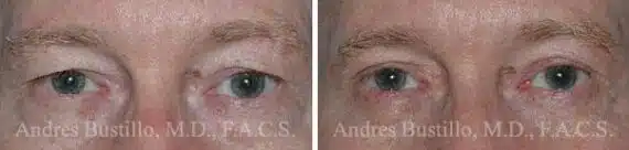 Blepharoplasty (eyelids) Before and After Photos in Miami, FL, Patient 15782