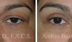 Blepharoplasty (eyelids) Before and After Photos in Miami, FL, Patient 15785