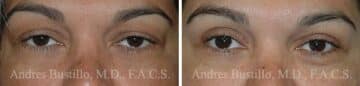 Blepharoplasty (eyelids) Before and After Photos in Miami, FL, Patient 15785