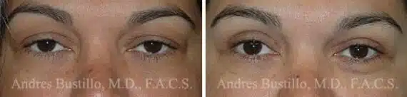 Blepharoplasty (eyelids) Before and After Photos in Miami, FL, Patient 15785