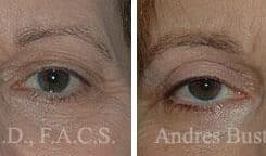 Blepharoplasty (eyelids) Before and After Photos in Miami, FL, Patient 15788