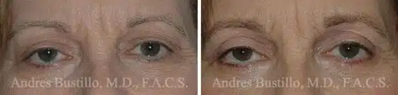 Blepharoplasty (eyelids) Before and After Photos in Miami, FL, Patient 15788