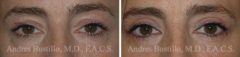 Blepharoplasty (eyelids) Before and After Photos in Miami, FL, Patient 15791