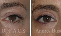 Blepharoplasty (eyelids) Before and After Photos in Miami, FL, Patient 15791