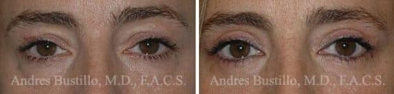 Blepharoplasty (eyelids) Before and After Photos in Miami, FL, Patient 15791