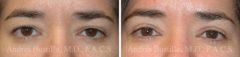 Blepharoplasty (eyelids) Before and After Photos in Miami, FL, Patient 15794