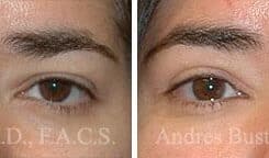 Blepharoplasty (eyelids) Before and After Photos in Miami, FL, Patient 15794