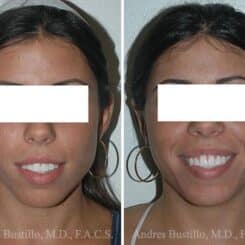 Otoplasty Before and After Photos in Miami, FL, Patient 15812