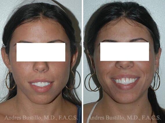 Otoplasty Before and After Photos in Miami, FL, Patient 15812