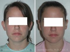 Otoplasty Before and After Photos in Miami, FL, Patient 15809