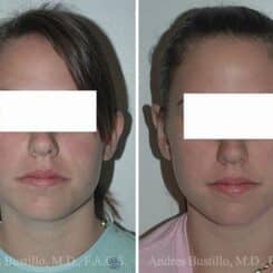 Otoplasty Before and After Photos in Miami, FL, Patient 15809