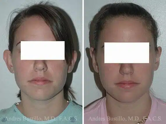 Otoplasty Before and After Photos in Miami, FL