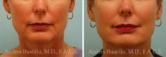 Dermal Filler Before and After Photos in Miami, FL, Patient 15824