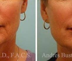 Dermal Filler Before and After Photos in Miami, FL, Patient 15824