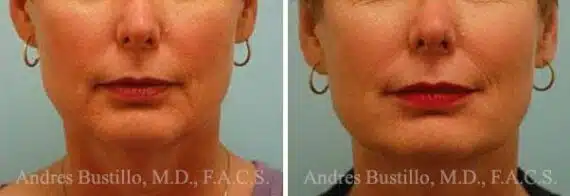 Dermal Filler Before and After Photos in Miami, FL, Patient 15824