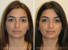 Rhinoplasty Before and After Photos in Miami, FL, Patient 15895