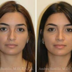 Rhinoplasty Before and After Photos in Miami, FL, Patient 15895