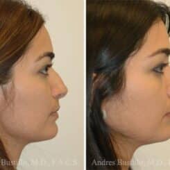 Rhinoplasty Before and After Photos in Miami, FL, Patient 15895